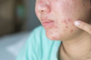 Tretinoin for Acne